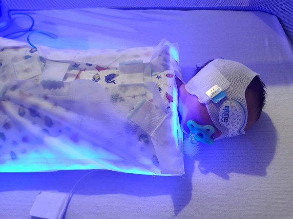 Cocoon allows jaundice babies to be treated at home